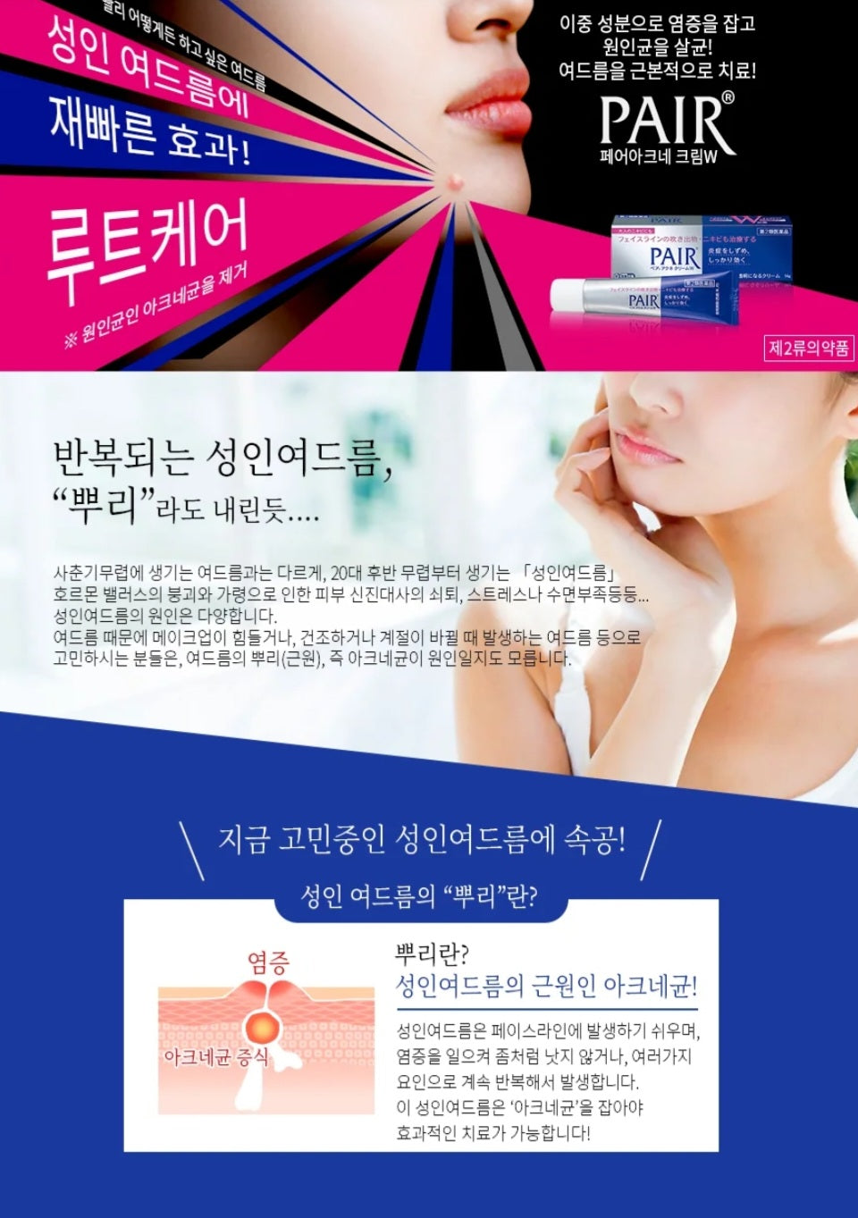 일본 국민 여드름 치료연고!!아.크.네 페어 24g
